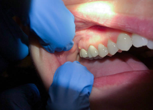 Best Chipped Tooth Repair Near Me  in Fort Valley, GA